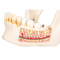 Zahnerkrankung, 2-fache Größe, 21-teilig – 3B Smart Anatomy 